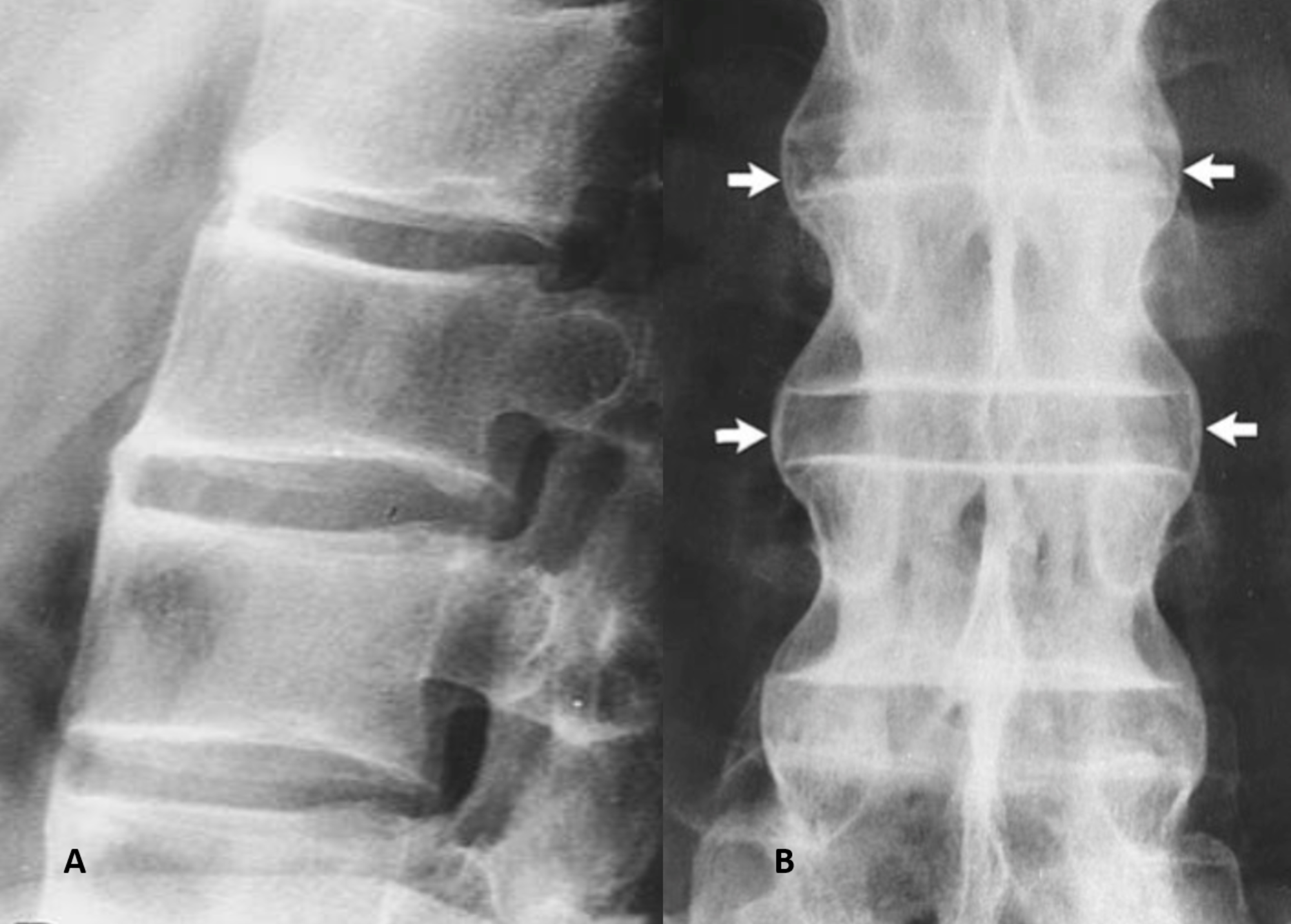 ankylosing spondylitis cervical spine x ray