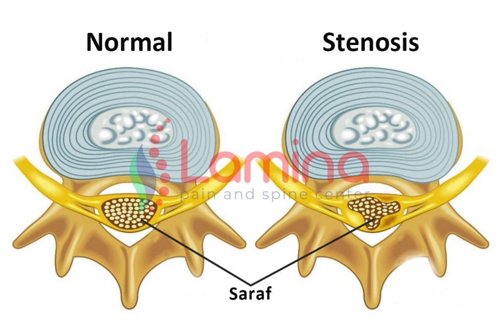 stenosis spinal adalah