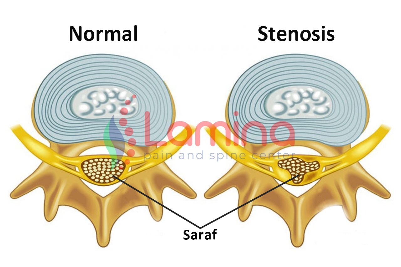 Stenosis Spinal Adalah Penyebab Kesemutan dan Nyeri