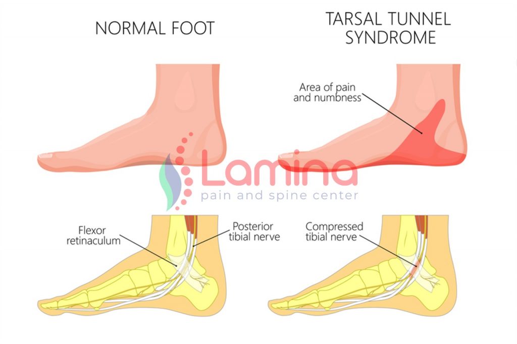 saraf kejepit kaki tarsal tunnel syndrome