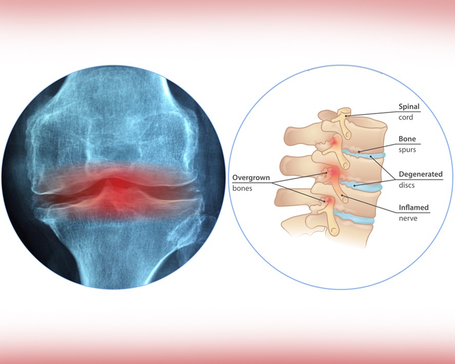 Osteofit Adalah Penyebab Masalah pada Tulang dan Nyeri