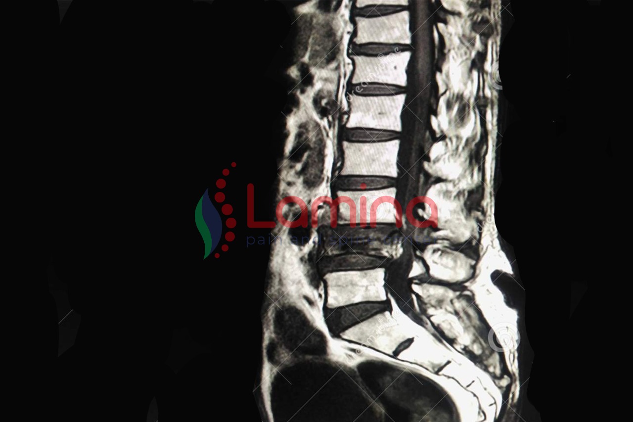 Penyakit Osteoporosis Penyebab Tulang Belakang Keropos, Atasi dengan Kifoplasti