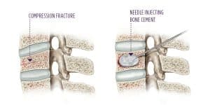 kyphoplasty - Lamina Pain and Spine Center