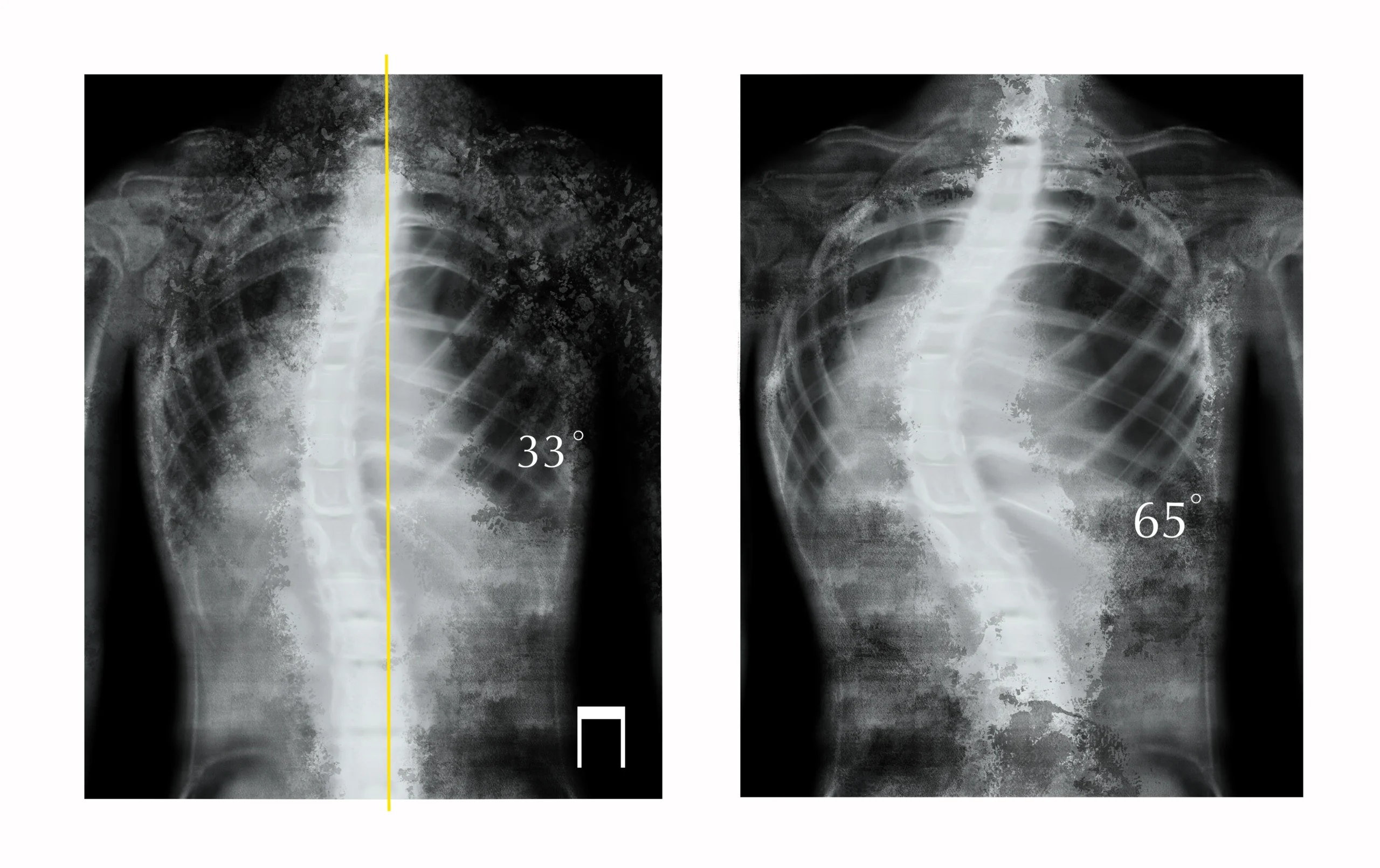 Waspadai Bahaya Skoliosis yang Tidak Ditangani dengan Baik - Lamina Pain and Spine Center