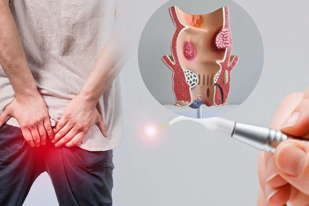 teknologi medis modern - laser hemorrhoidoplasty